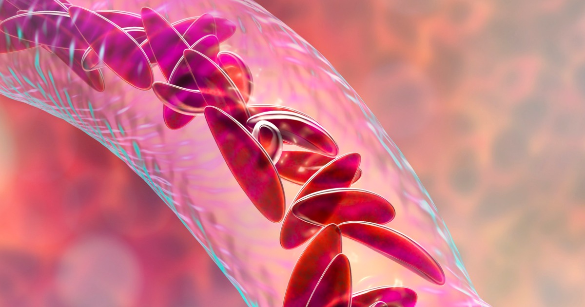 medical marijuana for Sickle Cell Anemia